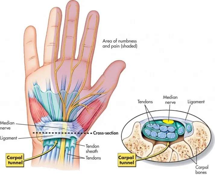Diagram of the hand, showing the carpal tunnel and areas affected by carpal tunnel syndrome