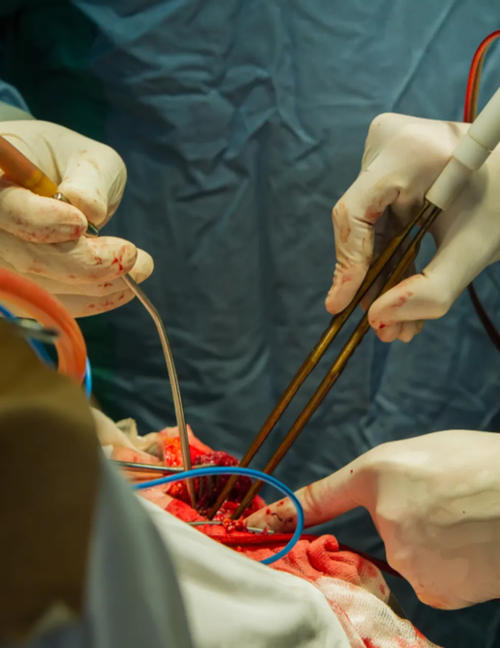 Craniotomy Surgery Adelaide Craniotomy Surgery Adelaide