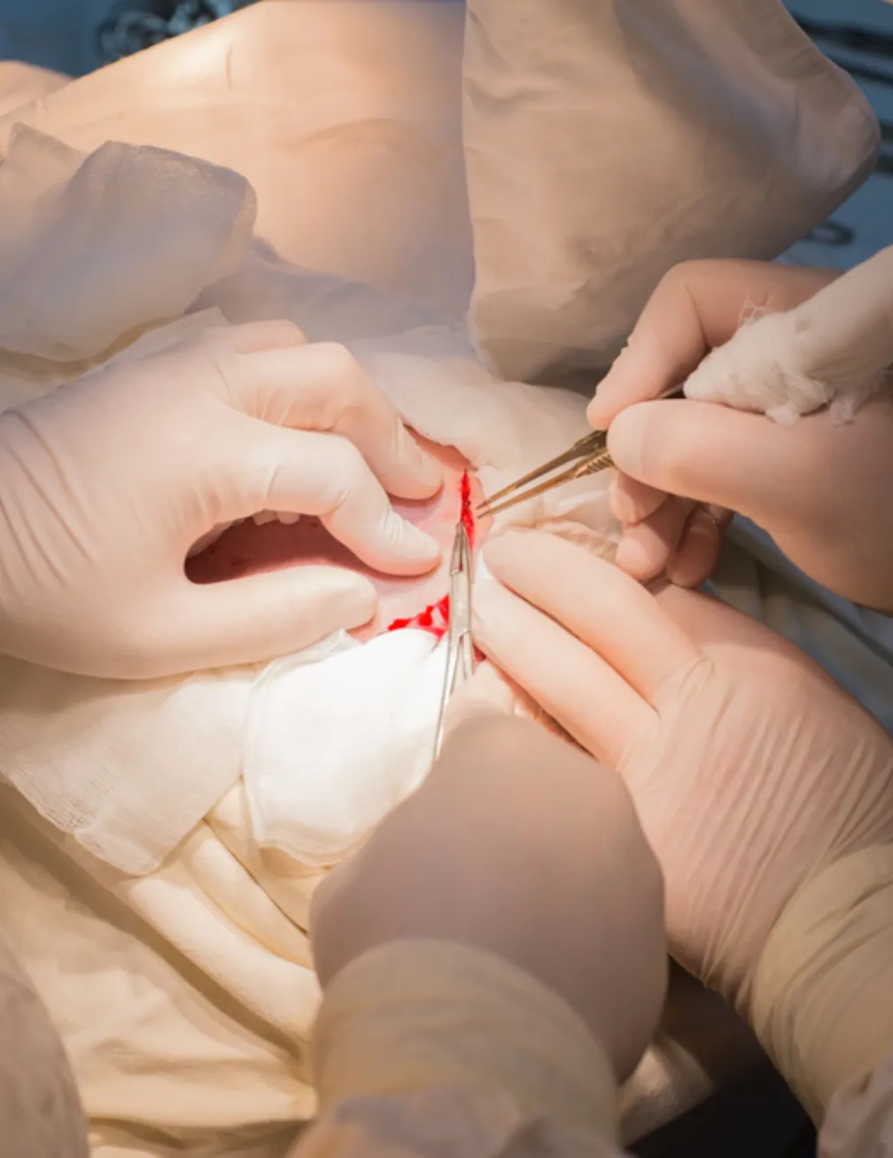 Craniotomy Surgery Adelaide Craniotomy Surgery Adelaide